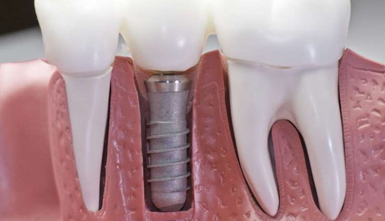 Guide On Dental Implants