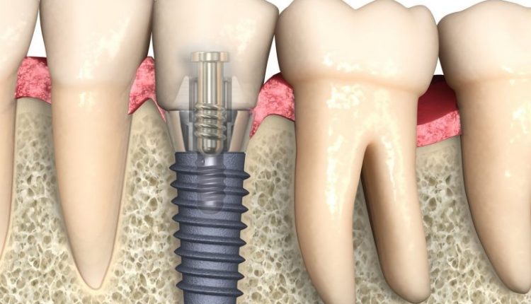 Guide On Dental Implants1